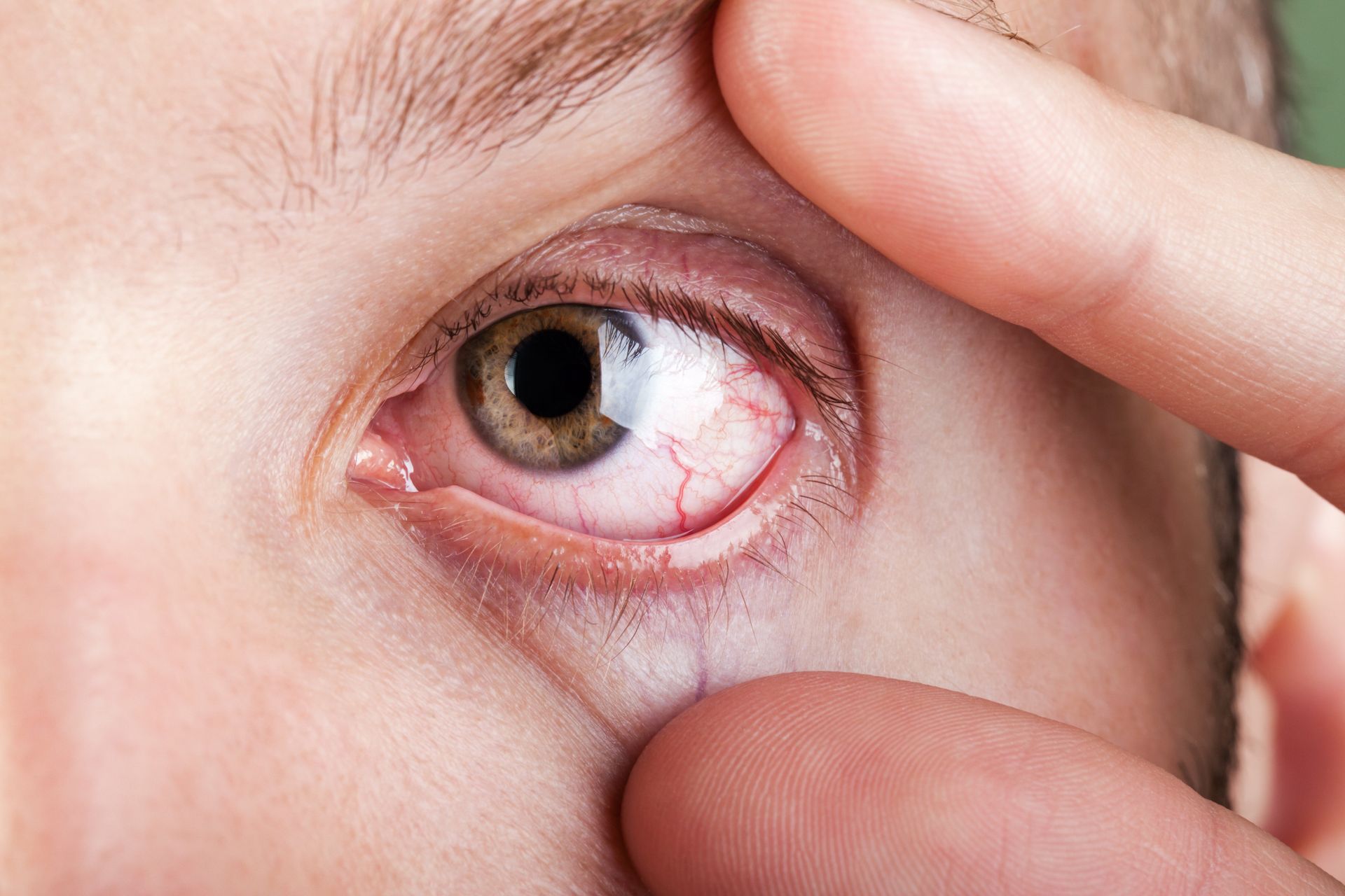 a red and irritated eye